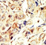 IGF1R / IGF1 Receptor Antibody - Formalin-fixed and paraffin-embedded human cancer tissue reacted with the primary antibody, which was peroxidase-conjugated to the secondary antibody, followed by DAB staining. This data demonstrates the use of this antibody for immunohistochemistry; clinical relevance has not been evaluated. BC = breast carcinoma; HC = hepatocarcinoma.