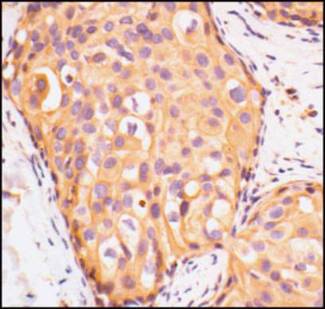 IGF1R / IGF1 Receptor Antibody - IHC of paraffin-embedded human breast tumor section, showing membrane and cytoplasmic staining, using Insulin-Like Growth Factor I Receptor, beta (IGF1Rb).