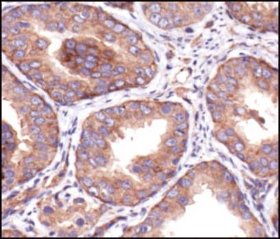 IGF1R / IGF1 Receptor Antibody - IHC of paraffin-embedded human prostate carcinoma using Insulin-Like Growth Factor I Receptor, beta (IGF1Rb).