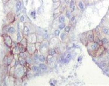 IGF1R / IGF1 Receptor Antibody - Immunohistochemistry localization of IGF1R in paraffin-embedded human endometrial carcinoma (uterus).