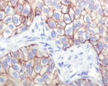 IGF1R / IGF1 Receptor Antibody - Immunohistochemistry localization of IGF1R in paraffin-embedded human lung squamous cell carcinoma.