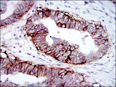 IGF1R / IGF1 Receptor Antibody - IHC of paraffin-embedded ovarian cancer tissues using IGF1R-Beta mouse monoclonal antibody with DAB staining.
