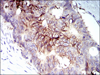 IGF1R / IGF1 Receptor Antibody - IHC of paraffin-embedded rectum cancer tissues using IGF1R-Beta mouse monoclonal antibody with DAB staining.