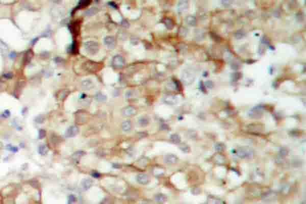 IGF1R / IGF1 Receptor Antibody - IHC of IGF-1R (G1155) antibody in paraffin-embedded human breast carcinoma tissue.