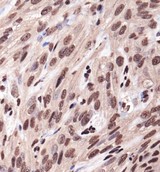 IGF1R / IGF1 Receptor Antibody - Immunohistochemistry: IGF1 Receptor Antibody - Analysis of IGF1R in human kidney carcinoma using DAB with hematoxylin counterstain.  This image was taken for the unconjugated form of this product. Other forms have not been tested.