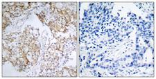 IGF1R / IGF1 Receptor Antibody - Immunohistochemistry analysis of paraffin-embedded human breast carcinoma, using IGF1R (Phospho-Tyr1161) Antibody. The picture on the right is blocked with the phospho peptide.