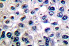 IGF1R / IGF1 Receptor Antibody - IHC of p-IGF-1R (Y1161) pAb in paraffin-embedded human breast carcinoma tissue.