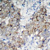 IGF1R / IGF1 Receptor Antibody - Immunohistochemical analysis of paraffin-embedded human breast carcinoma tissue.