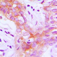 IGF1R / IGF1 Receptor Antibody - Immunohistochemical analysis of IGF1 Receptor (pY1161) staining in human breast cancer formalin fixed paraffin embedded tissue section. The section was pre-treated using heat mediated antigen retrieval with sodium citrate buffer (pH 6.0). The section was then incubated with the antibody at room temperature and detected using an HRP conjugated compact polymer system. DAB was used as the chromogen. The section was then counterstained with hematoxylin and mounted with DPX.