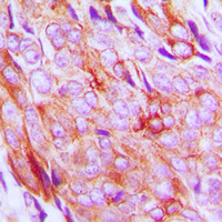IGF1R / IGF1 Receptor Antibody - Immunohistochemical analysis of IGF1 Receptor (pY1161) staining in human breast cancer formalin fixed paraffin embedded tissue section. The section was pre-treated using heat mediated antigen retrieval with sodium citrate buffer (pH 6.0). The section was then incubated with the antibody at room temperature and detected using an HRP conjugated compact polymer system. DAB was used as the chromogen. The section was then counterstained with hematoxylin and mounted with DPX.