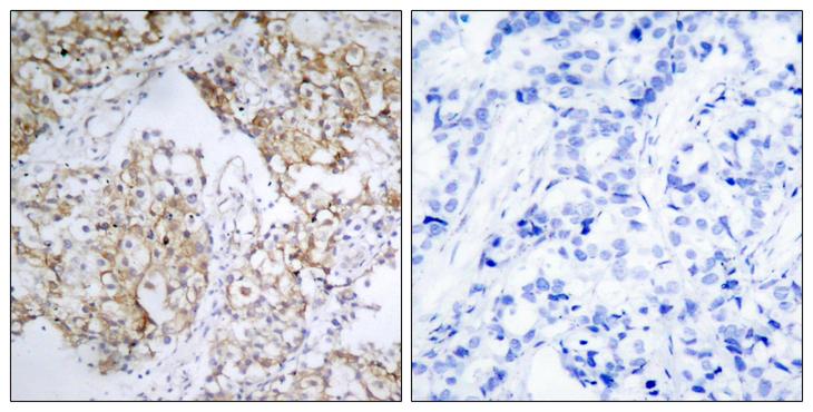 IGF1R / IGF1 Receptor Antibody - P-Peptide - + Immunohistochemical analysis of paraffin- embedded human breast carcinoma tissue using IGF-1R (phospho-Tyr1161) antibody.