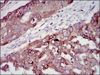 IGF2 Antibody - IHC of paraffin-embedded ovarian cancer tissues using IGF2 mouse monoclonal antibody with DAB staining.