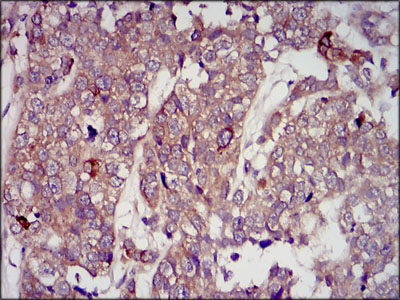 IGF2 Antibody - IHC of paraffin-embedded bladder cancer tissues using IGF2 mouse monoclonal antibody with DAB staining.
