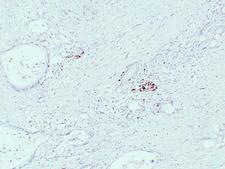 IGF2 Antibody - Pancreatic Carcinoma 1