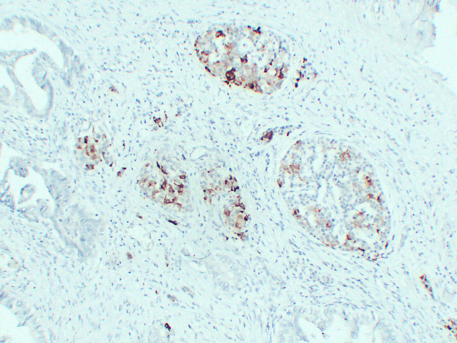 IGF2 Antibody - Pancreatic Carcinoma 4