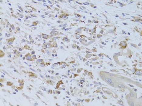 IGF2 Antibody - Immunohistochemistry of paraffin-embedded human breast cancer using IGF2 Antibody at dilution of 1:100 (40x lens).