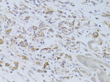 IGF2 Antibody - Immunohistochemistry of paraffin-embedded Human breast cancer using IGF2 Polyclonal Antibody at dilution of 1:100 (40x lens).