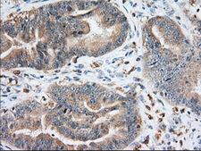 IGF2BP2 Antibody - Immunohistochemical staining of paraffin-embedded Adenocarcinoma of Human colon tissue using anti-IGF2BP2 mouse monoclonal antibody. (Dilution 1:50).