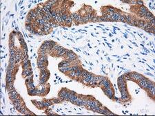 IGF2BP2 Antibody - Immunohistochemical staining of paraffin-embedded Adenocarcinoma of Human colon tissue using anti-IGF2BP2 mouse monoclonal antibody. (Dilution 1:50).