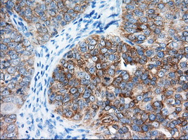 IGF2BP2 Antibody - Immunohistochemical staining of paraffin-embedded Adenocarcinoma of Human ovary tissue using anti-IGF2BP2 mouse monoclonal antibody. (Dilution 1:50).