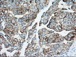IGF2BP2 Antibody - Immunohistochemical staining of paraffin-embedded Adenocarcinoma of Human ovary tissue using anti-IGF2BP2 mouse monoclonal antibody. (Heat-induced epitope retrieval by 10mM citric buffer, pH6.0, 100C for 10min, Dilution 1:50)