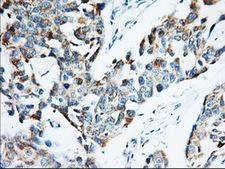 IGF2BP2 Antibody - Immunohistochemical staining of paraffin-embedded Adenocarcinoma of Human breast tissue using anti-IGF2BP2 mouse monoclonal antibody. (Heat-induced epitope retrieval by 10mM citric buffer, pH6.0, 100C for 10min, Dilution 1:50)
