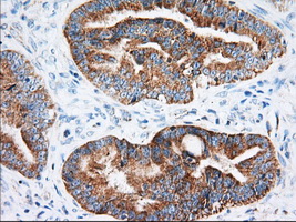 IGF2BP2 Antibody - Immunohistochemical staining of paraffin-embedded Adenocarcinoma of Human colon tissue using anti-IGF2BP2 mouse monoclonal antibody. (Heat-induced epitope retrieval by 10mM citric buffer, pH6.0, 100C for 10min, Dilution 1:50)