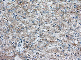 IGF2BP2 Antibody - Immunohistochemical staining of paraffin-embedded Human liver tissue using anti-IGF2BP2 mouse monoclonal antibody. (Dilution 1:50).