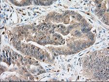 IGF2BP2 Antibody - IHC of paraffin-embedded Adenocarcinoma of Human colon tissue using anti-IGF2BP2 mouse monoclonal antibody. (Dilution 1:50).
