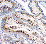 IGF2R / CD222 Antibody - IGF2R / CD222 antibody. IHC(P): Human Intestinal Cancer Tissue.