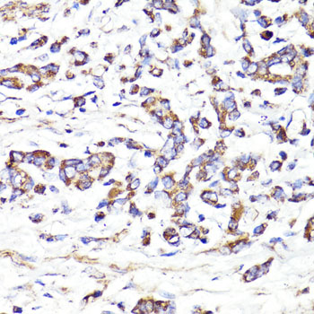 IGF2R / CD222 Antibody - Immunohistochemistry of paraffin-embedded human gastric cancer using IGF2R antibody at dilution of 1:100 (40x lens).