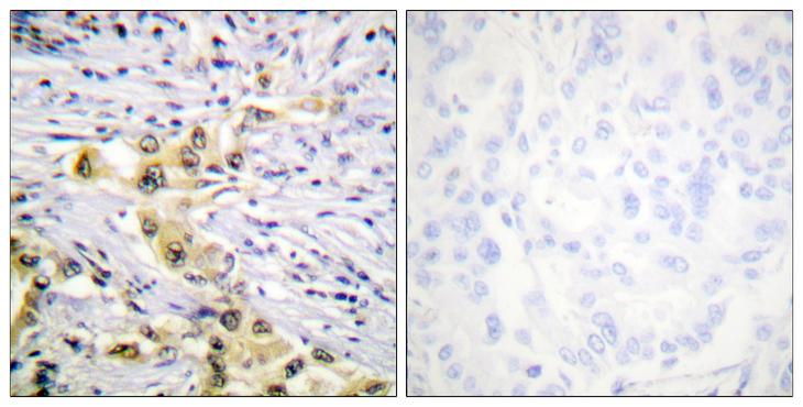 IGF2R / CD222 Antibody - Peptide - + Immunohistochemistry analysis of paraffin-embedded human lung carcinoma tissue using IGF2R antibody.