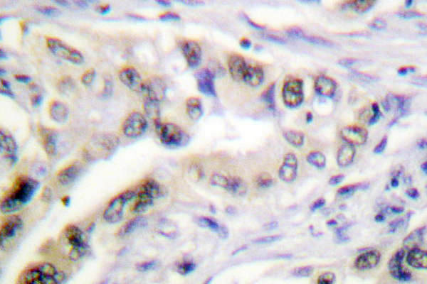 IGF2R / CD222 Antibody - IHC of IGF-2R (F2480) pAb in paraffin-embedded human lung carcinoma tissue.