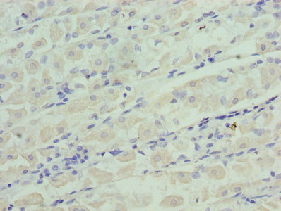 IGFBP1 Antibody - Immunohistochemistry of paraffin-embedded human gastric cancer using IGFBP1 Antibody at dilution of 1:100