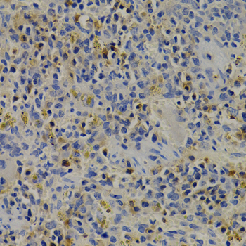 IGFBP1 Antibody - Immunohistochemistry of paraffin-embedded human liver cancer tissue.