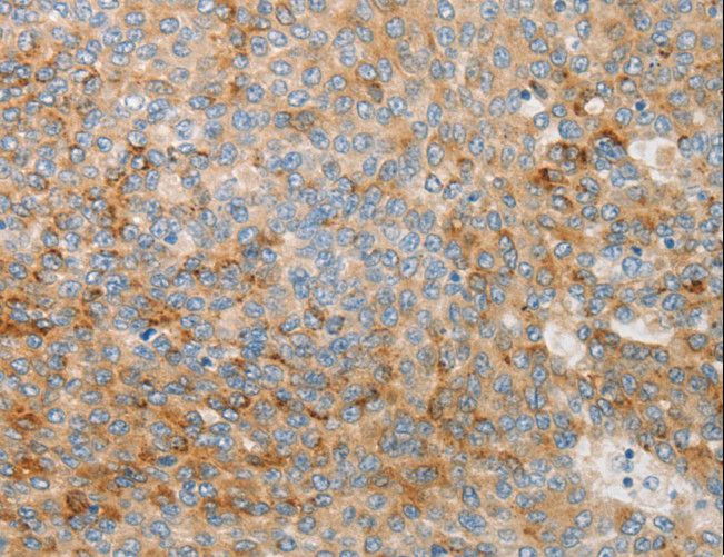 IGFBP1 Antibody - Immunohistochemistry of paraffin-embedded Human liver cancer using IGFBP1 Polyclonal Antibody at dilution of 1:30.