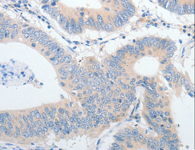 IGFBP1 Antibody - Immunohistochemistry of paraffin-embedded Human colon cancer using IGFBP1 Polyclonal Antibody at dilution of 1:30.