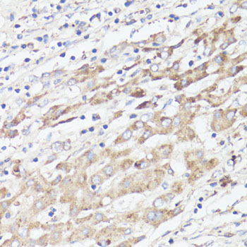 IGFBP1 Antibody - Immunohistochemistry of paraffin-embedded human liver cancer using IGFBP1 antibody at dilution of 1:100 (40x lens).
