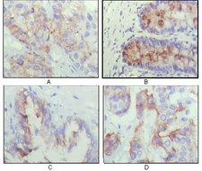 IGFBP2 / IGF-BP53 Antibody - IHC of paraffin-embedded human lung cancer (A), recturn(B), prostate (C), colon cancer (D) showing cytoplasmic localization using IGFBP2 mouse monoclonal antibody with DAB staining.