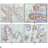 IGFBP2 / IGF-BP53 Antibody - Immunohistochemistry (IHC) analysis of paraffin-embedded human lung cancer (A), recturn(B), prostate (C), colon cancer (D) showing cytoplasmic localization with DAB staining using IGFBP2 Monoclonal Antibody.