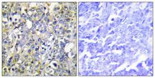 IGFBP3 Antibody - Immunohistochemistry analysis of paraffin-embedded human lung carcinoma tissue, using IGFBP-3 Antibody. The picture on the right is blocked with the synthesized peptide.