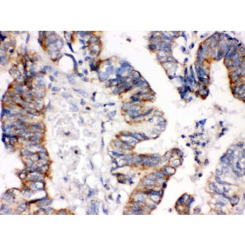 IGFBP3 Antibody - IGFBP3 antibody IHC-paraffin. IHC(P): Human Intestinal Cancer Tissue.