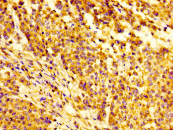 IGFBP6 Antibody - Immunohistochemistry image of paraffin-embedded human colon cancer at a dilution of 1:100