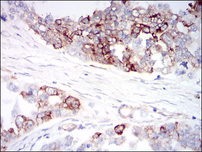 IGFBP7 / TAF Antibody - IHC of paraffin-embedded ovarian cancer tissues using CK5 mouse monoclonal antibody with DAB staining.