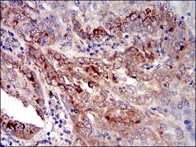 IGFBP7 / TAF Antibody - IHC of paraffin-embedded cervical cancer tissues using CK5 mouse monoclonal antibody with DAB staining.