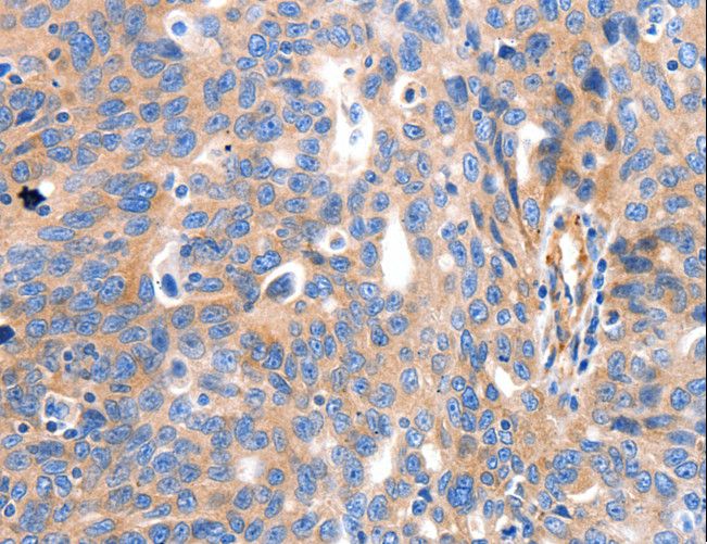 IGFBP7 / TAF Antibody - Immunohistochemistry of paraffin-embedded Human ovarian cancer using IGFBP7 Polyclonal Antibody at dilution of 1:50.