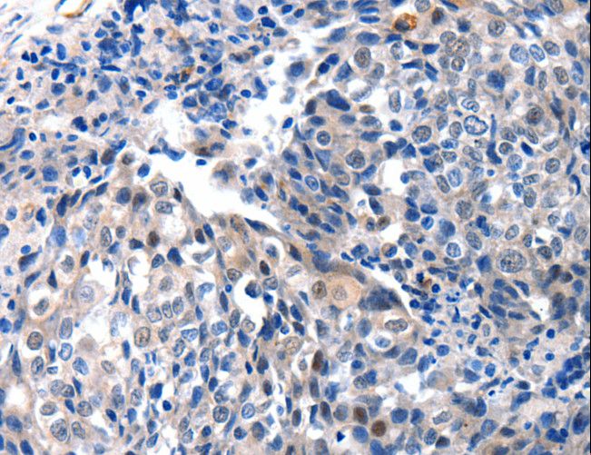 IGFBP7 / TAF Antibody - Immunohistochemistry of paraffin-embedded Human breast cancer using IGFBP7 Polyclonal Antibody at dilution of 1:25.