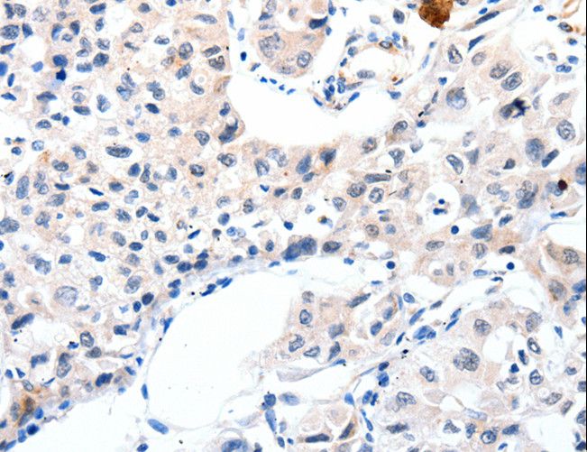 IGFBP7 / TAF Antibody - Immunohistochemistry of paraffin-embedded Human lung cancer using IGFBP7 Polyclonal Antibody at dilution of 1:25.