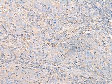 IGHA1 / IgA1 Antibody - Immunohistochemistry of paraffin-embedded Human cervical cancer tissue  using IGHA1 Polyclonal Antibody at dilution of 1:50(×200)