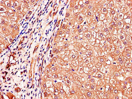 IGHMBP2 Antibody - Immunohistochemistry of paraffin-embedded human liver cancer using IGHMBP2 Antibody at dilution of 1:100